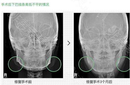 轮廓修复手术CT对比案例