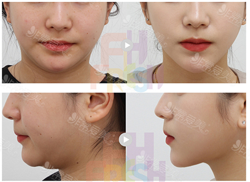 韩国芙莱思整形医院V脸吸脂轮廓术案例