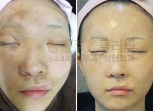 韩国清潭珠颜面部烧伤疤痕修复图