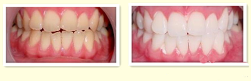 透明牙科医院牙齿美白案例