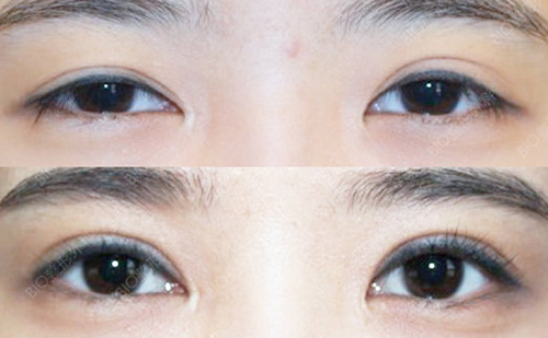 韩国BIO整形外科双眼皮修复案例