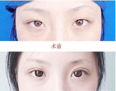 什么样的双眼皮比较容易修复
