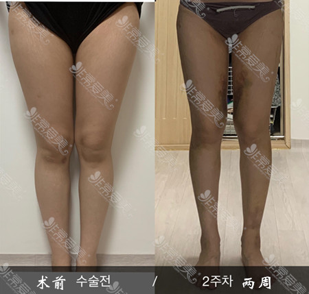 韩国365MC抽脂抽大腿案例