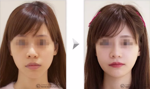 日本MAXFACS GINZA CLINIC美容整形医院面部轮廓手术案例