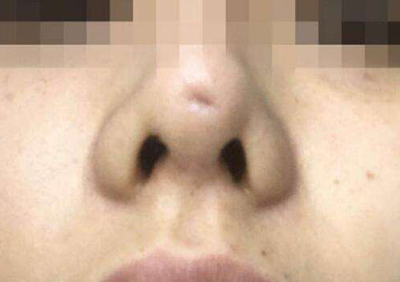假体隆鼻后鼻尖凹陷