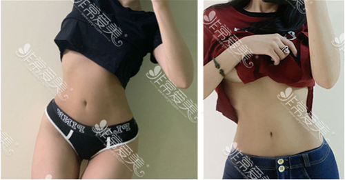 babiline医院腰腹吸脂效果