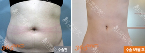 腰腹抽脂800毫升正常吗