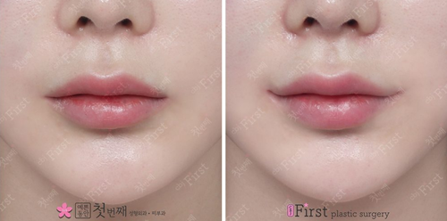 韩国初见医院唇部整形对比图