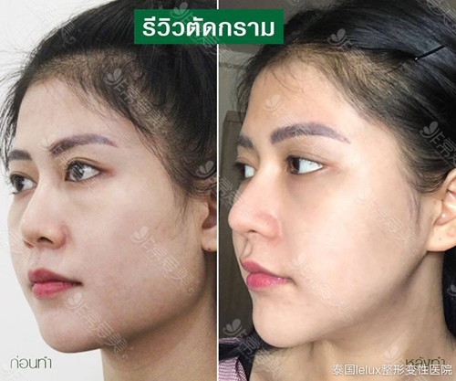 泰国lelux轮廓手术案例