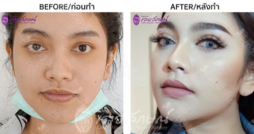泰国lelux整形外科鼻整形图片