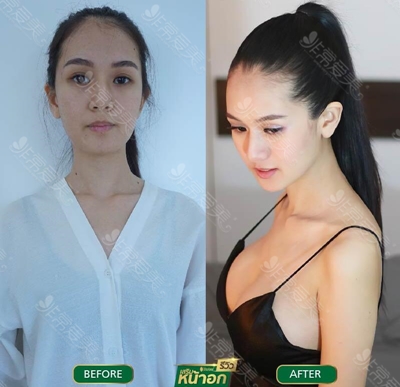 泰国lelux隆胸案例图片