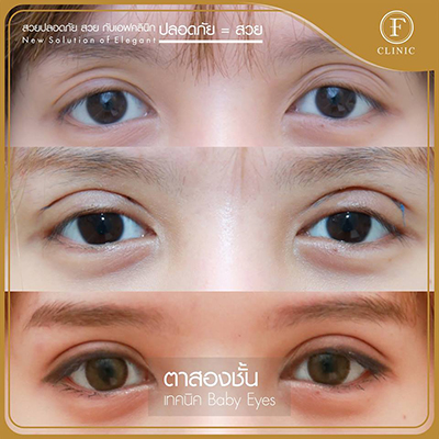 泰国曼谷F CLINIC诊所双眼皮日记图