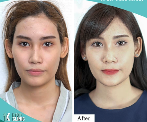 泰国面部脂肪填充手术对比案例