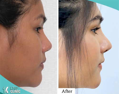 泰国KTOP整形鼻部整形手术对比案例
