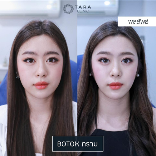 泰国TARA CLINIC 医院瘦脸针案例