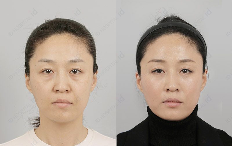 韩国ID整形外科祛眼袋整形案例
