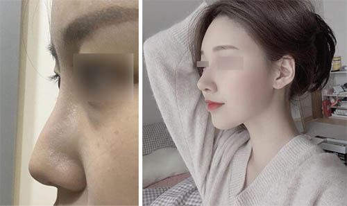 韩国louvre整形外科隆鼻图片