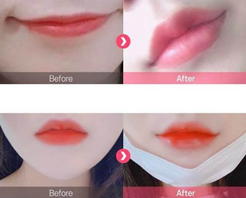 韩国SOME整形外科唇部整形照片