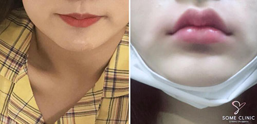 韩国SOME整形外科唇部整形案例
