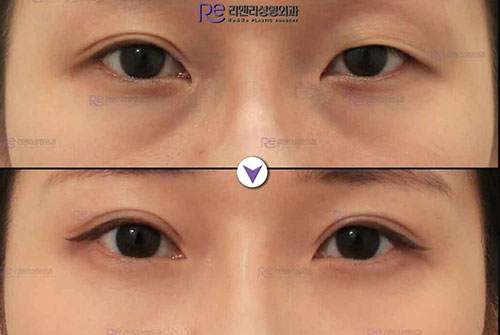 韩国丽颜丽整形外科眼部整形案例