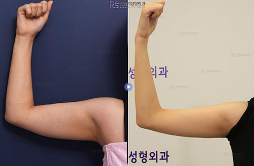 韩国丽颜丽整形外科手臂吸脂日记图