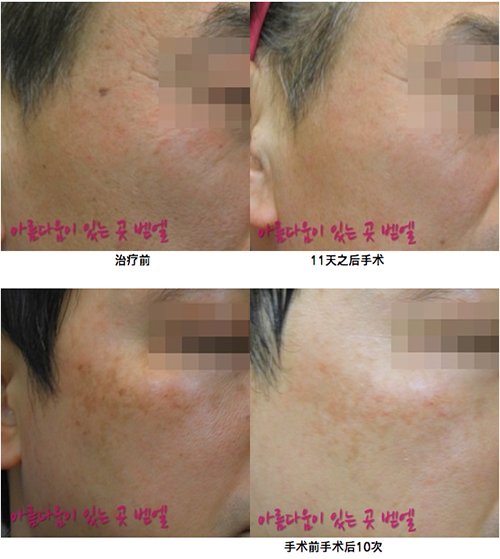 韩国bethel皮肤科医院皮肤治疗案例
