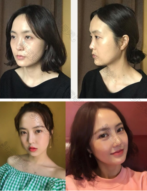 韩国普瑞美整形医院鼻部整形对比图 韩国普瑞美整形医院鼻部整形对比图