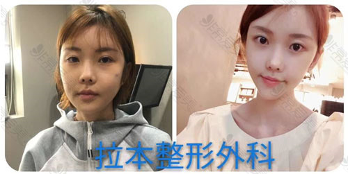 韩国拉本整形医院拉皮手术前后对比 韩国拉本整形医院拉皮手术前后对比