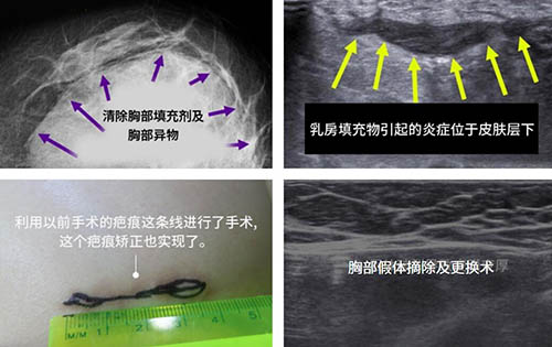 韩国shinyu整形外科胸部修复手术示意