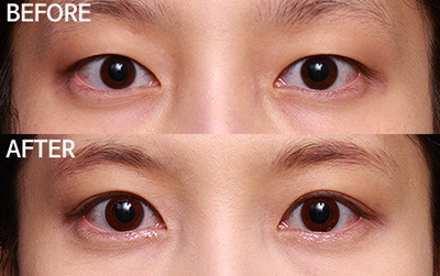 韩国双眼皮整形案例图