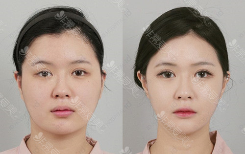 韩国ID整形医院激光溶脂日记图