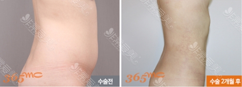 韩国365MC腰腹抽脂后多久能恢复