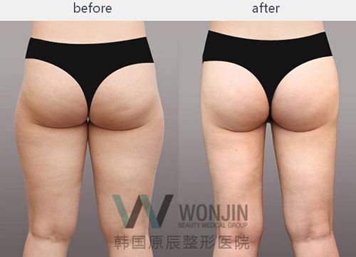 腿部吸脂手术前后对比图