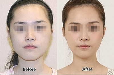 韩国林二石皮肤科注射瘦脸针效果图