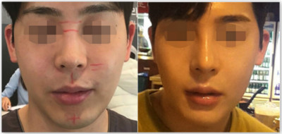 韩国glory整形外科男士隆鼻案例