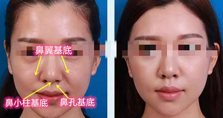 鼻基底填充前后对比图