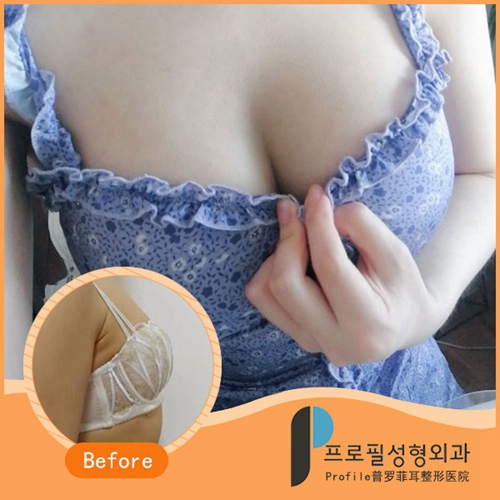 韩国普罗菲耳Profile整形医院隆胸案例图