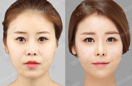韩国原辰整形外科自体脂肪填充对比