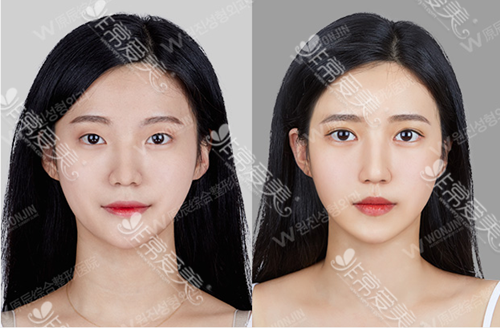 双眼皮不双怎么办