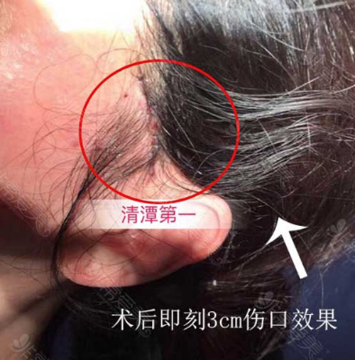 韩国清潭First整形医院小切口埋线提升疤痕位置 韩国清潭First整形医院小切口埋线提升疤痕位置