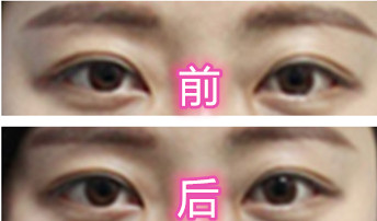 为什么有的人割完双眼皮，也没有变得<span style=