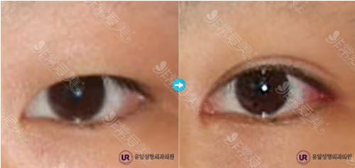 韩国UR整形外科全切双眼皮图片