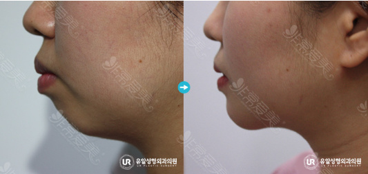 韩国UR整形外科假体下巴图片效果图