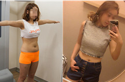 365mc医院腰腹吸脂案例