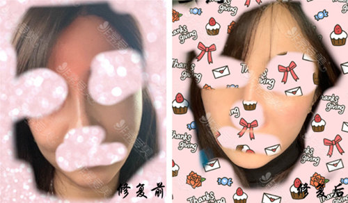 自体脂肪填充过量修复日记 自体脂肪填充过量修复日记