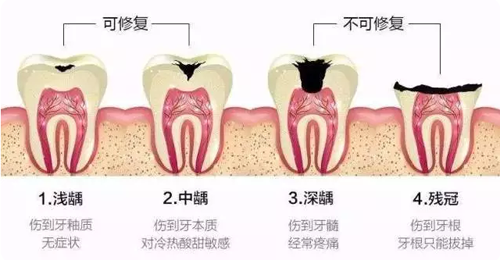 龋齿的几种情况展示