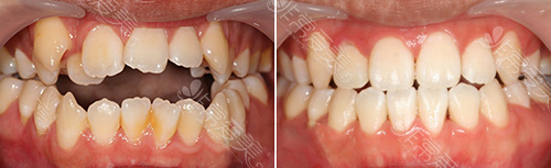 牙齿矫正案例
