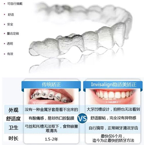 隐适美的优势