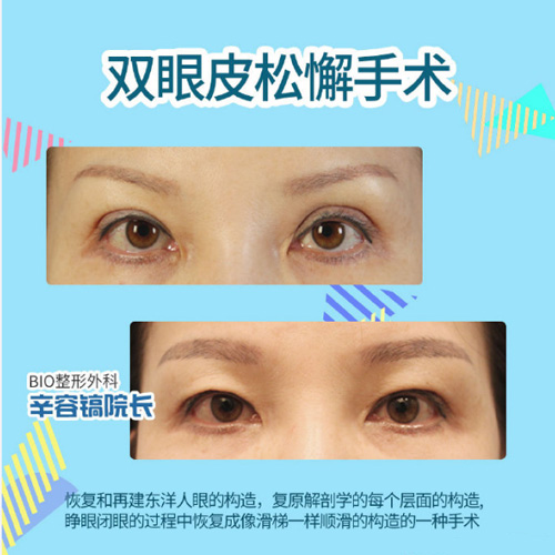 辛容镐双眼皮松懈前后对比