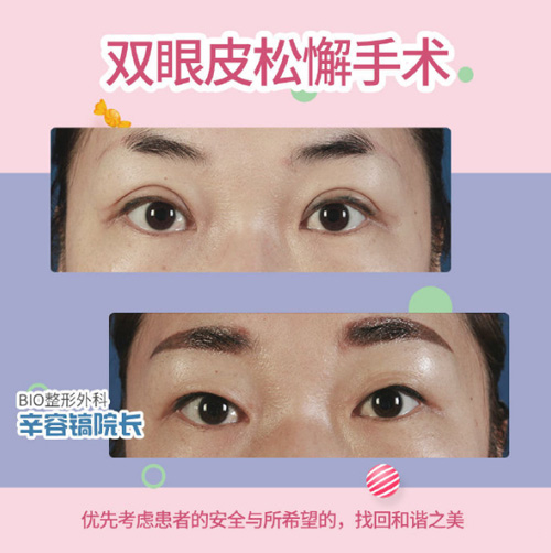 辛容镐双眼皮松解手术日记